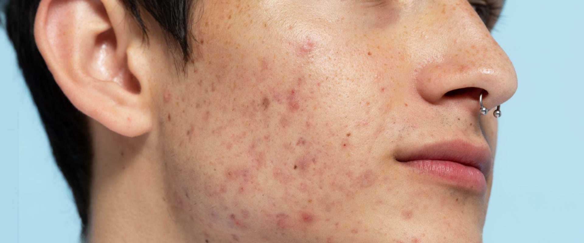 How do you stop the side effects of testosterone?