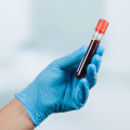 How often should you check your psa when taking testosterone?