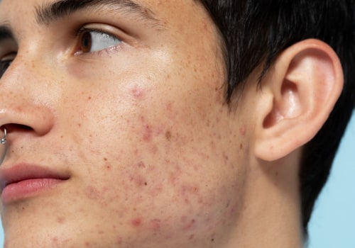 How do you stop the side effects of testosterone?