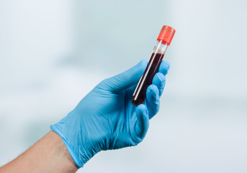 How often should you check your psa when taking testosterone?